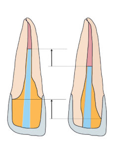 3. In presenza di maggiore perdita di tessuto della corona clinica, il perno in fibra deve essere inserito più profondamente nel canale radicolare per ottenere maggiore superficie di adesione.