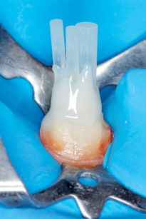 4-5. Situazione con cavità del canale radicolare dell’incisivo centrale sovraestesa. Si consiglia l’uso di più perni in fibra per compensare la contrazione della resina.
