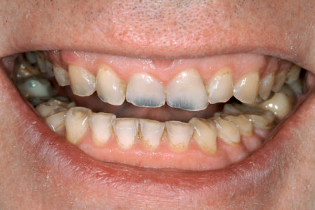 2a-2b. Situazione iniziale. Il paziente era molto a disagio nel mostrare i denti e solo dopo molti tentativi è stato ottenuto un sorriso forzato. Si noti la traslucenza accentuata a livello dei due incisivi centrali, indicante il grave assottigliamento dei bordi incisali. Il paziente aveva continuato a rimandare le cure dentali perché era contrario a un restauro con corone.