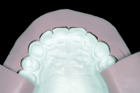 4a-4c. Analizzando la posizione lingualizzata dei due incisivi centrali, è stato considerato possibile un mock-up additivo. L’odontotecnico ha ingrandito leggermente tutti gli aspetti vestibolari dei denti mascellari per ridurre la necessità di una preparazione dentale al momento di applicare le faccette vestibolari. 