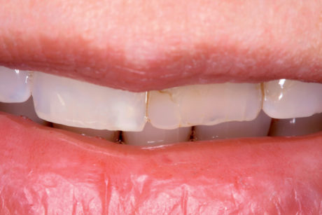 1. Dente 21 discolorato, trattato endodonticamente, causa del problema estetico della paziente 36enne.