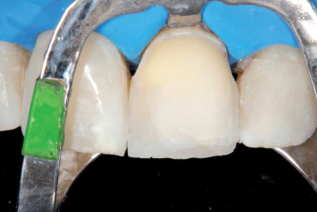 10. L’incisivo centrale mascellare sinistro dopo la riduzione del dente per l’applicazione della faccetta in composito e isolato con diga in gomma.