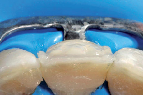 11. Vista occlusale del dente 21, seguita dalla creazione delle creste prossimali (smalto) e dei mammelloni (dentina). 