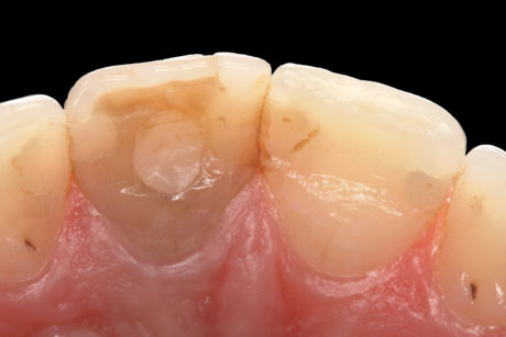 4. Vista palatale del dente 21 discolorato trattato endodonticamente.