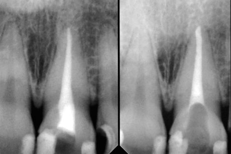 5. Radiografia prima (sinistra) e dopo (destra) il ritrattamento endodontico. 
