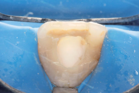 6. Miscela di perborato di sodio tetraidrato e di perossido di idrogeno al 3%, applicata nella camera pulpare del dente 21.