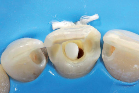 9. Tutto il vecchio materiale di otturazione in composito è stato rimosso e il perno in fibra è stato controllato all’interno dello spazio canalare del dente 21.