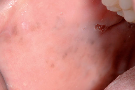 13. Malattia di Peutz-Jeghers con manifestazione sulla mucosa geniena: si notino le pigmentazioni sparse sulla mucosa.