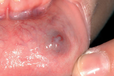 22a. Mucocele del labbro inferiore a patogenesi traumatica.