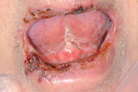 45. Coinvolgimento esteso delle labbra in corso di pemfigo paraneoplastico (associato a patologia linfomatosa).