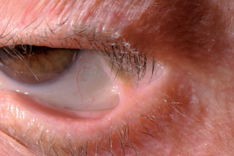 47. Simblefaron causato da pemfigoide delle membrane mucose: evidente la lacinia fibrosa che unisce palpebra inferiore e bulbo oculare.