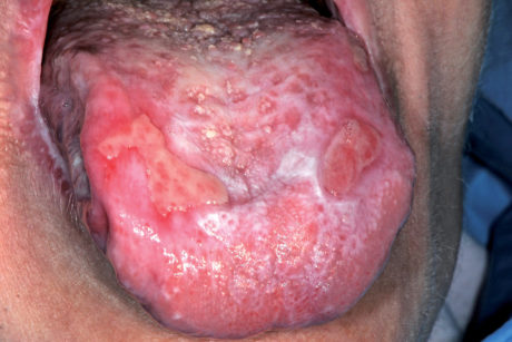 58. Lichen bolloso della lingua: causa disfagia.
