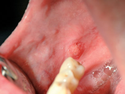 59. Carcinoma insorto su mucosa interessata da lichen planus.