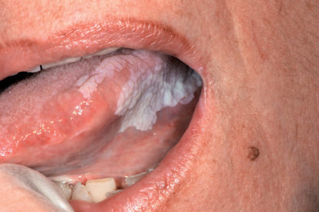 61. Leucoplachia ad aspetto verrucoso della mucosa linguale.