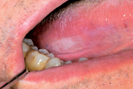 62. Leucoplachia disomogenea (leucoeritroplachia) del margine linguale.