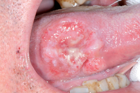 70. Carcinoma infiltrante del margine linguale. Aspetto ulcerativo.