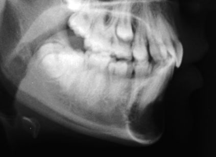 1b. Teleradiografia latero-laterale del cranio eseguita per valutazione ortodontica che evidenzia lesione osteolitica in regione sinfisaria 