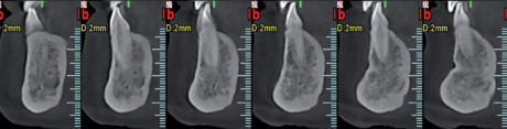 12a-12b. Tomografia computerizzata a 24 mesi dall’enucleazione della lesione: si evidenzia un grado di ossificazione del sito post-chirurgico qualitativamente e quantitativamente soddisfacente. Le scansioni assiali (12b) evidenziano la completa ri-ossificazione della cavità residua