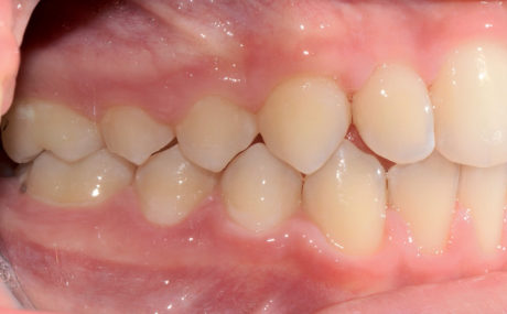 1. Prima classe molare