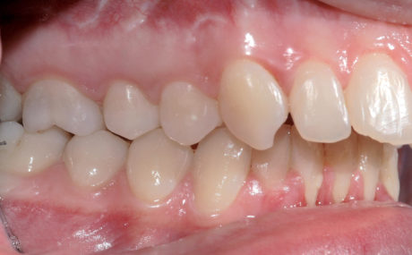 2. Seconda classe molare