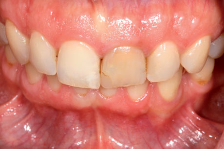 2. La fotografia intraorale mostra la relazione occlusale e il colore del dente 21 rispetto agli altri denti anteriori. 