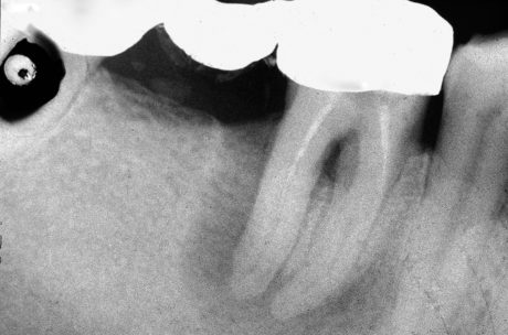 1. Il paziente S.A. si presenta alla nostra osservazione riferendo dolore alla masticazione nell’area inferiore destra della bocca. L’esame radiografico evidenzia che l’elemento 4.6, pilastro di ponte, presenta un’estesa area radiotrasparente periapicale. Il trattamento endodontico esistente è incongruo in quanto non interessa tutto il sistema canalare, inoltre si può vedere una perforazione nell’area della forca.