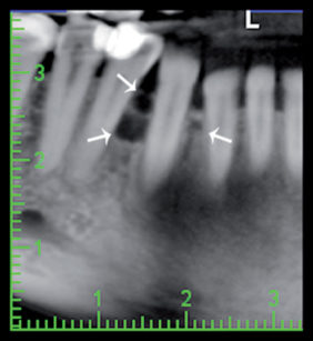 2. Aspetto radiografico nella panorex, notare l’aspetto multiloculare
