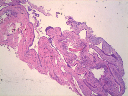 7. Aspetto microscopico della lesione, si nota l’epitelio pavimentoso non stratificato e la presenza di numerosi addensamenti epiteliali
