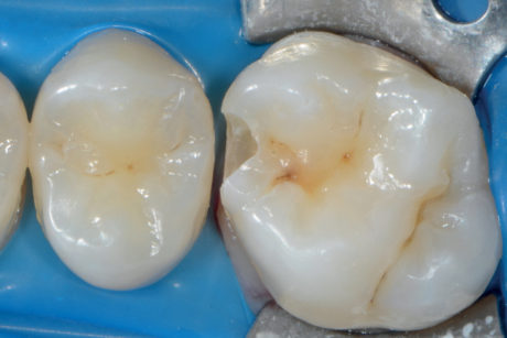 1e. Cavità che raggiunge la dentina
