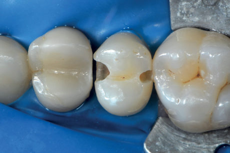 2f. Entrambe le cavità coinvolgono la dentina