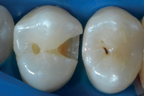 4d. Cavità estesa alla dentina
