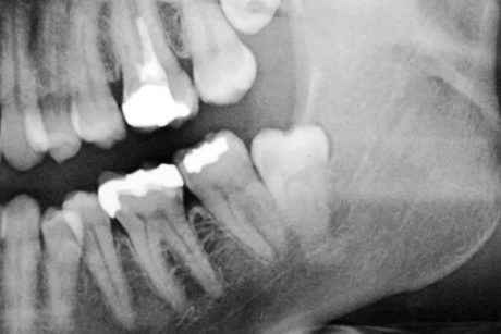 1. Deviazione e restringimento del canale mandibolare