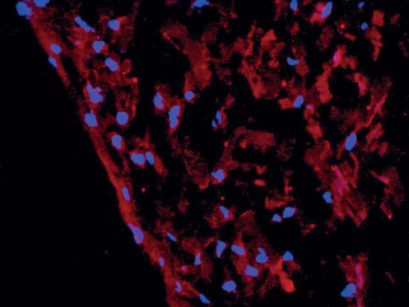 Cellule staminali seminate su biomateriali a base di acido ialuronico. Crescono in 3 dimensioni ricostruendo un tessuto simile al derma (immagine al microscopio a fluorescenza: in blu il nucleo della cellula, in rosso la matrice extracellulare prodotta delle cellule)