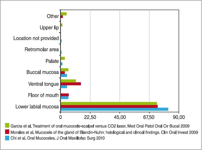 Ranule e mucoceli del cavo orale: eziopatogenesi, varianti e trattamento