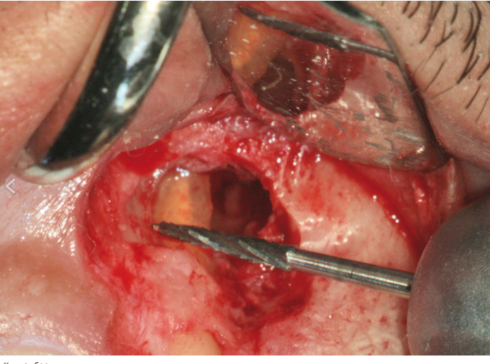 DM_il dentista moderno_lesione periapicale_apicectomia_trattamento e risoluzione