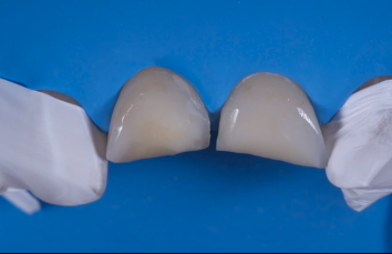 traumi dentali epidemiologia direct-restoration-frontal-teeth