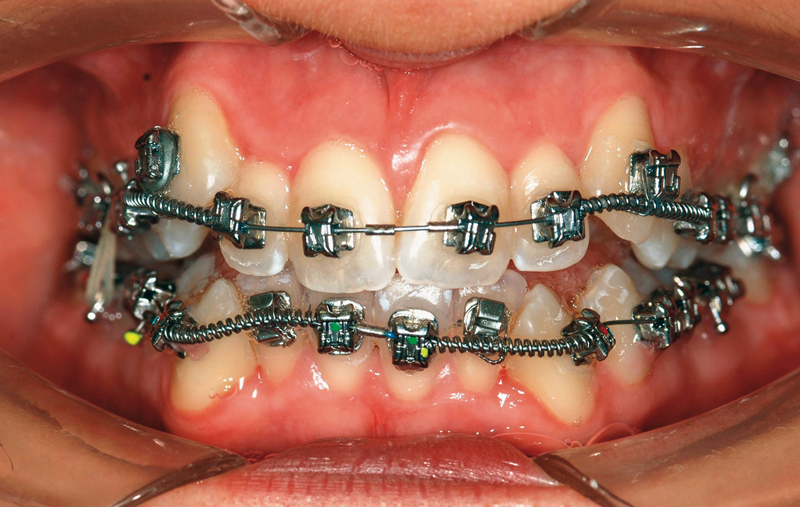 Elastici ortodontici con apparecchio linguale: inserimento con