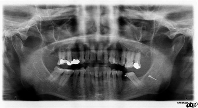 studio odontoiatrico recupero-chirurgico-di-una-minivite-ortodontica-pavimento-orale