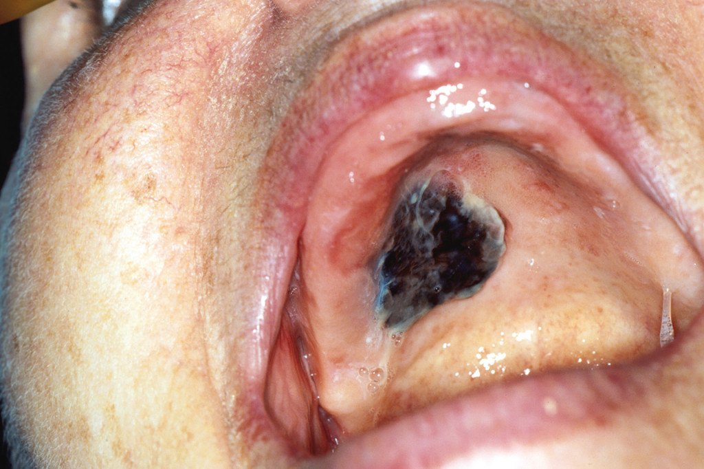 Melanoma nodulare primitivo della cavità orale