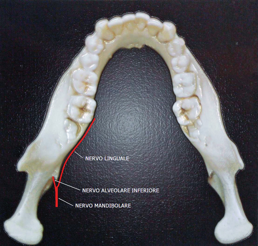 Lesione del nervo linguale in seguito a chirurgia dei terzi molari odontoiatria