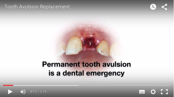 Avulsed. Permanent Tooth