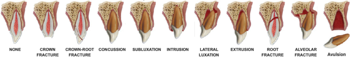 Eziologia dei traumi dentali legamento parodontale classificazione