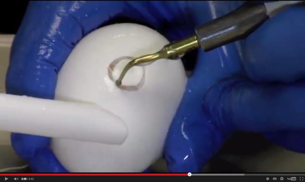 DM_il dentista moderno_Ultrasuoni utilizzo della tecnologia piezoelettrica in odontoiatria