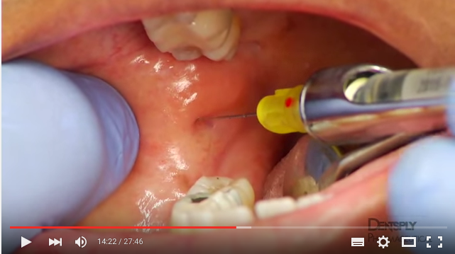 DM_il dentista moderno_dolore_anestesia tronculare del nervo alveolare inferiore odontoiatria_vasocostrittore in odontoiatria