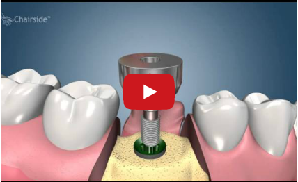 DM_il dentista moderno_implantologia a carico immediato_2 stages