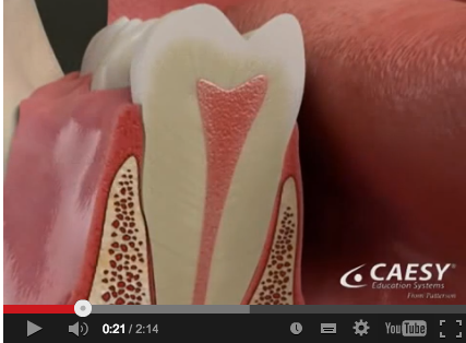 Necrosi Dentale Periodontite Apicale Ascesso Granuloma E Cisti Odontogena