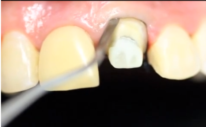 DM_il dentista moderno_fili di retrazione gengivale_impronte dentali