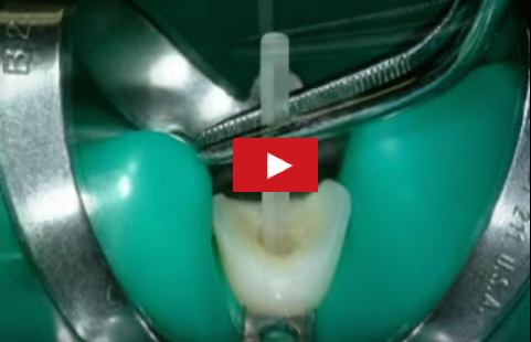 DM_il dentista moderno_ricostruzione post endodontica dente devitalizzato