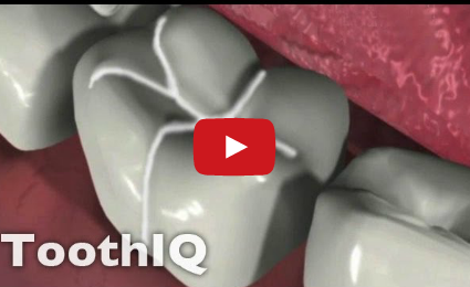 DM_il dentista moderno_sigillature carie odontoiatra