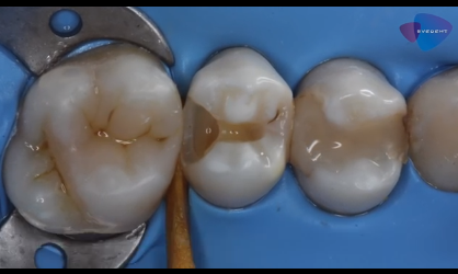 DM_il dentista moderno_ seconda classe di Black_premolare